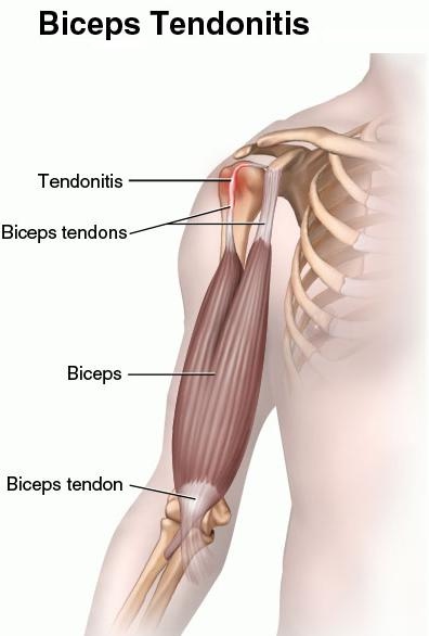 biceps tendonopathy/tendonitis