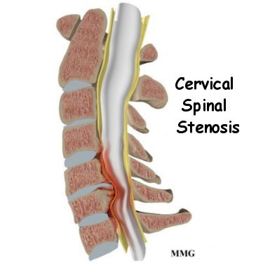 cervical spinal stensis sheboygan wi chiropractor 
