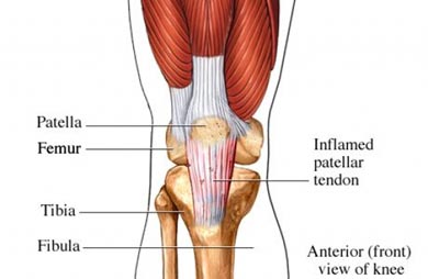 infra patellar tendonitis